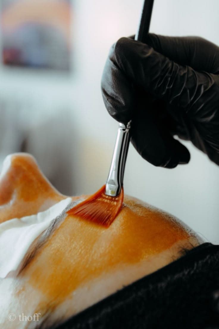 Chemical Peels