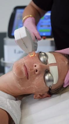 IPL Photofacial
